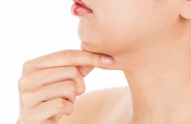 kybella treatment