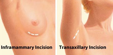 breast augmentation incision locations