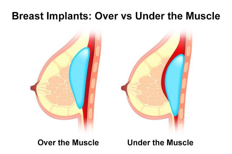 Infographic image of what breast implants look like over and under the muscle