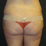 Liposuction Before & After Image