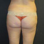 Liposuction Before & After Image