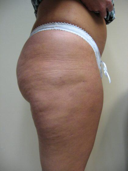 Liposuction Before & After Image