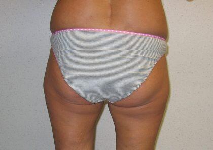 Liposuction Before & After Image