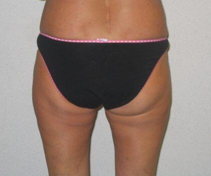 Liposuction Before & After Image