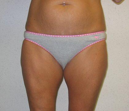 Liposuction Before & After Image