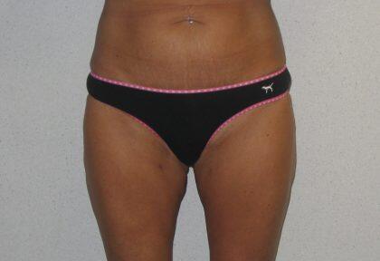 Liposuction Before & After Image