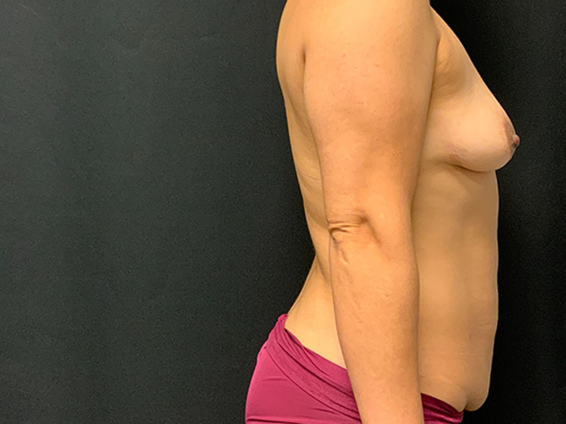 Mommy Makeover Before & After Image
