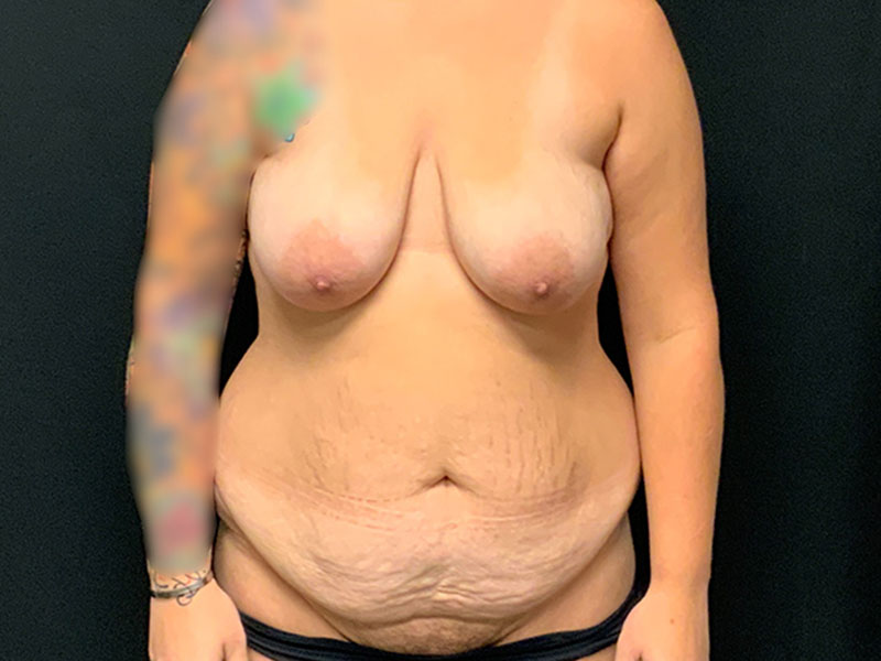 Mommy Makeover Before & After Image