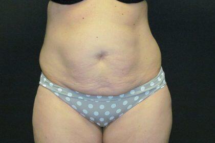 Tummy Tuck Before & After Image