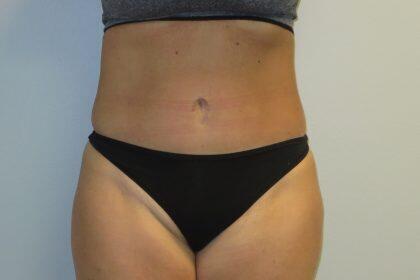 Tummy Tuck Before & After Image