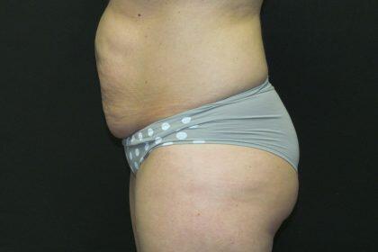 Tummy Tuck Before & After Image