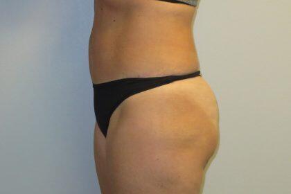 Tummy Tuck Before & After Image