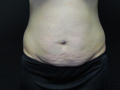 Tummy Tuck Before & After Image