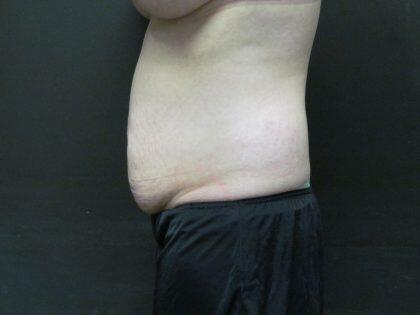 Tummy Tuck Before & After Image