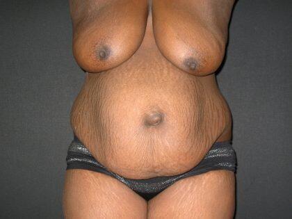 Tummy Tuck Before & After Image