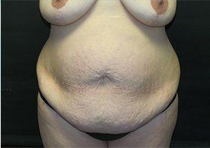 Tummy Tuck Before & After Image