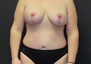 Tummy Tuck Before & After Image