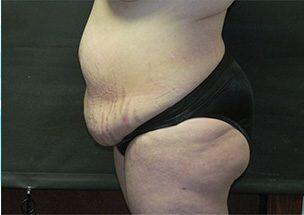 Tummy Tuck Before & After Image