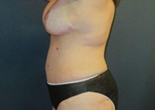 Tummy Tuck Before & After Image