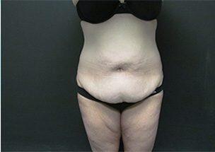 Tummy Tuck Before & After Image