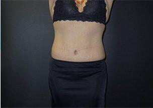 Tummy Tuck Before & After Image