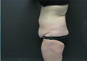 Tummy Tuck Before & After Image