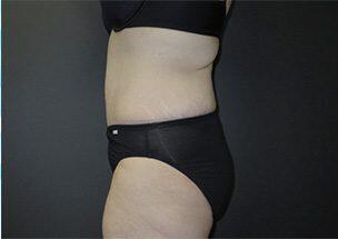 Tummy Tuck Before & After Image