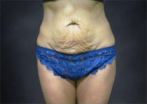 Tummy Tuck Before & After Image