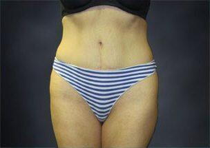 Tummy Tuck Before & After Image