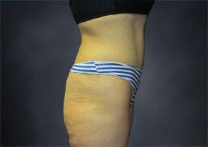 Tummy Tuck Before & After Image