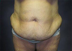 Tummy Tuck Before & After Image