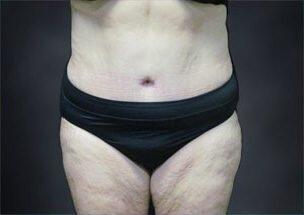 Tummy Tuck Before & After Image