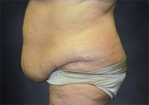 Tummy Tuck Before & After Image