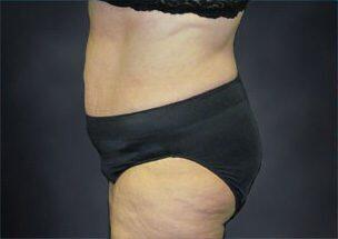 Tummy Tuck Before & After Image