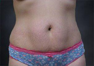 Tummy Tuck Before & After Image