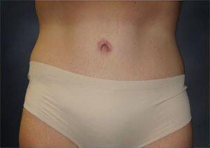 Tummy Tuck Before & After Image