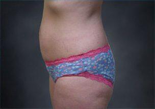 Tummy Tuck Before & After Image