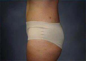 Tummy Tuck Before & After Image