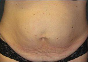 Tummy Tuck Before & After Image