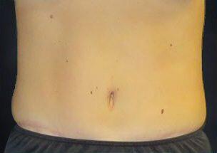 Tummy Tuck Before & After Image