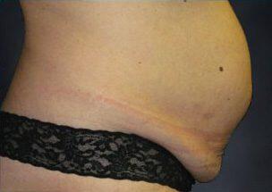 Tummy Tuck Before & After Image