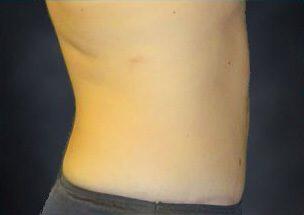 Tummy Tuck Before & After Image