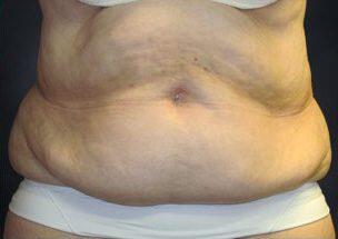 Tummy Tuck Before & After Image