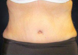 Tummy Tuck Before & After Image