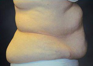 Tummy Tuck Before & After Image