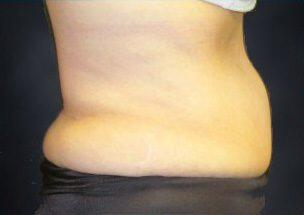 Tummy Tuck Before & After Image