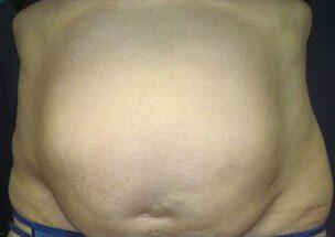 Tummy Tuck Before & After Image