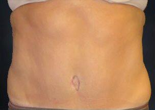 Tummy Tuck Before & After Image