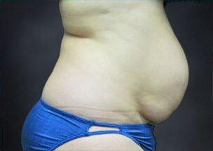 Tummy Tuck Before & After Image