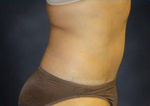 Tummy Tuck Before & After Image